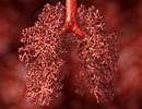 Right Ventricular Morphology Predictive of Pulmonary Hypertension Type Right Ventricular Morphology Predictive of Pulmonary Hypertension Type