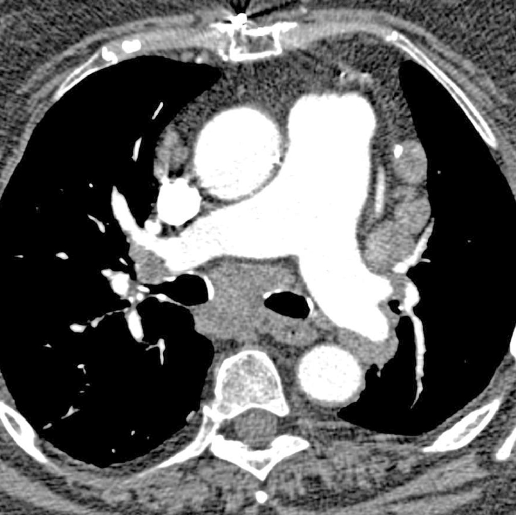 Pulmonary Arterial Hypertension: Future Treatment May 