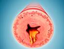Delafloxacin Effective for Community-Acquired Respiratory Tract Infections Delafloxacin Effective for Community-Acquired Respiratory Tract Infections