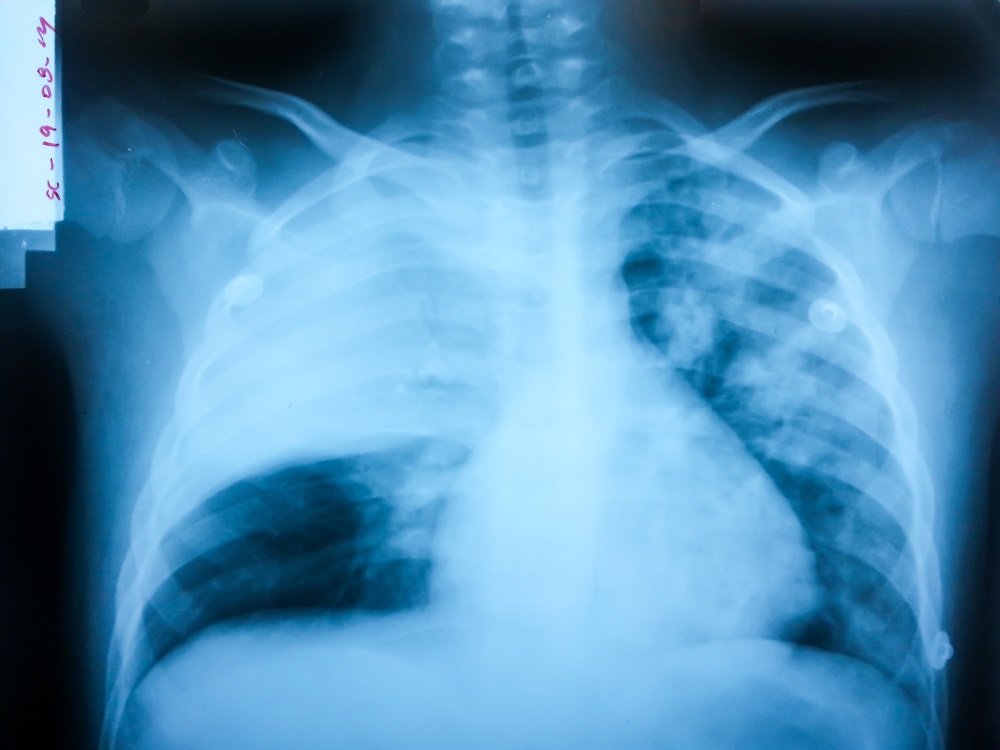 Effect Of Corticosteroids On Pneumonia