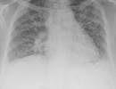 Prophylactic Azithromycin Beneficial in Idiopathic Pulmonary Fibrosis Prophylactic Azithromycin Beneficial in Idiopathic Pulmonary Fibrosis