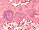 Using Coronary Artery Calcium to Predict Cardiovascular Events in COPD Using Coronary Artery Calcium to Predict Cardiovascular Events in COPD