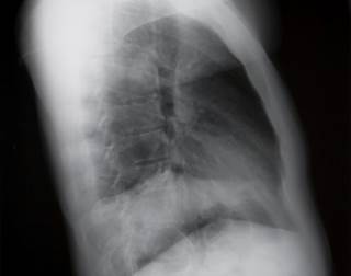 Researchers compared first generation EGFR-tyrosine kinase inhibitors to second generation agents. Researchers compared first generation EGFR-tyrosine kinase inhibitors to second generation agents.