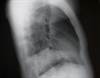 Dacomitinib vs Gefitinib for Progression-Free Survival in Non-small Cell Lung Cancer Dacomitinib vs Gefitinib for Progression-Free Survival in Non-small Cell Lung Cancer