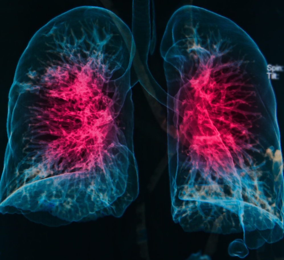 Inhaled Corticosteroids Do Not Increase Risk for Pneumonia 