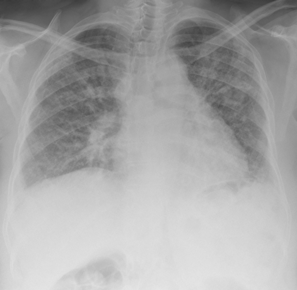 Summary of 2018 Idiopathic Pulmonary Fibrosis Diagnostic Guidelines ...