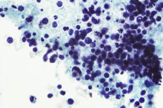 Some patients experience grade 3 or worse toxicities when receiving pazopanib. Some patients experience grade 3 or worse toxicities when receiving pazopanib.