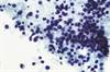 Small Cell Lung Cancer Survival With Anticoagulant Therapy Small Cell Lung Cancer Survival With Anticoagulant Therapy
