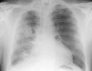 Mesothelioma Progression-Free Survival Does Not Improve With Anetumab Ravtansine Mesothelioma Progression-Free Survival Does Not Improve With Anetumab Ravtansine