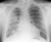 Mesothelioma Progression-Free Survival Does Not Improve With Anetumab Ravtansine Mesothelioma Progression-Free Survival Does Not Improve With Anetumab Ravtansine