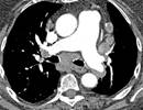 Pulmonary Arterial Compliance Improved With Riociguat vs PDE5 Inhibitors Pulmonary Arterial Compliance Improved With Riociguat vs PDE5 Inhibitors