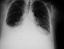 Pulmonary Edema After Prostacyclin Therapy for PAH Associated With Worse Outcomes Pulmonary Edema After Prostacyclin Therapy for PAH Associated With Worse Outcomes