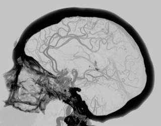 Having an impaired cerebral pressure-flow relationship can result in passively transmitted blood pressure changes to the brain. Having an impaired cerebral pressure-flow relationship can result in passively transmitted blood pressure changes to the brain.