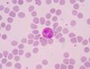 Biomarkers Useful for Differentiating Between Asthma and COPD Biomarkers Useful for Differentiating Between Asthma and COPD