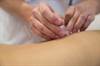 Cancer-Related Fatigue May Benefit From Acupuncture Cancer-Related Fatigue May Benefit From Acupuncture