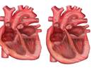 Riociguat Studied in Pediatric Patient With Pulmonary Arterial Hypertension Riociguat Studied in Pediatric Patient With Pulmonary Arterial Hypertension