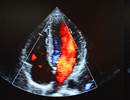 HIV Viral Loads May Affect Echocardiographic Pulmonary Pressure HIV Viral Loads May Affect Echocardiographic Pulmonary Pressure