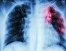 Latent Tuberculosis Testing and Treatment Recommendations Latent Tuberculosis Testing and Treatment Recommendations