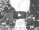 Examining the Efficacy of Carbon Monoxide Therapy in Idiopathic Pulmonary Fibrosis: An Interview With Augustine M.K. Choi, MD Examining the Efficacy of Carbon Monoxide Therapy in Idiopathic Pulmonary Fibrosis: An Interview With Augustine M.K. Choi, MD