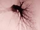 Pulmonary Embolism Prevalence in Acute COPD Exacerbations Pulmonary Embolism Prevalence in Acute COPD Exacerbations