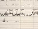 Apnea/Hypopnea Index in OSA Improves With Dronabinol Apnea/Hypopnea Index in OSA Improves With Dronabinol