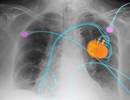 A 67-Year-Old Woman With Hypertension, Diabetes Presents With Shortness of Breath A 67-Year-Old Woman With Hypertension, Diabetes Presents With Shortness of Breath