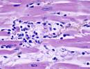 A 44-Year-Old Man With Persistent Upper Respiratory Infection A 44-Year-Old Man With Persistent Upper Respiratory Infection