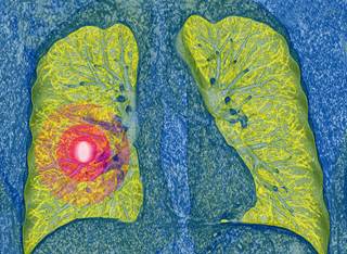 Researchers compared the risk for thromboembolic events in patients with lung cancer who were treated with either cisplatin or carboplatin. Researchers compared the risk for thromboembolic events in patients with lung cancer who were treated with either cisplatin or carboplatin.