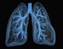 Incidence of Non-Ventilator Hospital-Acquired Pneumonia Incidence of Non-Ventilator Hospital-Acquired Pneumonia