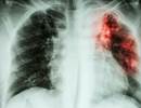 Tuberculosis Risk in Type 2 Diabetes Medications Tuberculosis Risk in Type 2 Diabetes Medications