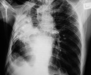 Pneumonia In Childhood Linked To Higher Short Term Incidence Of Some 