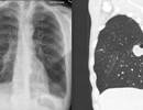 Lung Cancer Screening Requires Effective Risk Stratification Lung Cancer Screening Requires Effective Risk Stratification