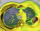 Emphysema Associated With Worse Outcomes in Heart Failure Emphysema Associated With Worse Outcomes in Heart Failure