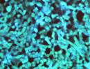 ABPA Complicating Asthma: Treatment Responses to Prednisolone vs Itraconazole ABPA Complicating Asthma: Treatment Responses to Prednisolone vs Itraconazole