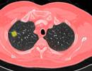 Lung Cancer Screening: Updated Guidelines From CHEST Lung Cancer Screening: Updated Guidelines From CHEST