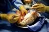 COPD-Related Lung Transplantation: How Can We Improve Survival Rates? COPD-Related Lung Transplantation: How Can We Improve Survival Rates?
