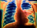 An Inflammatory Response: Cardiovascular Complications of Pneumonia An Inflammatory Response: Cardiovascular Complications of Pneumonia