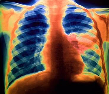 An Inflammatory Response: Cardiovascular Complications of Pneumonia An Inflammatory Response: Cardiovascular Complications of Pneumonia
