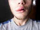 Lanadelumab Reduced Attack Rates in Hereditary Angioedema Lanadelumab Reduced Attack Rates in Hereditary Angioedema
