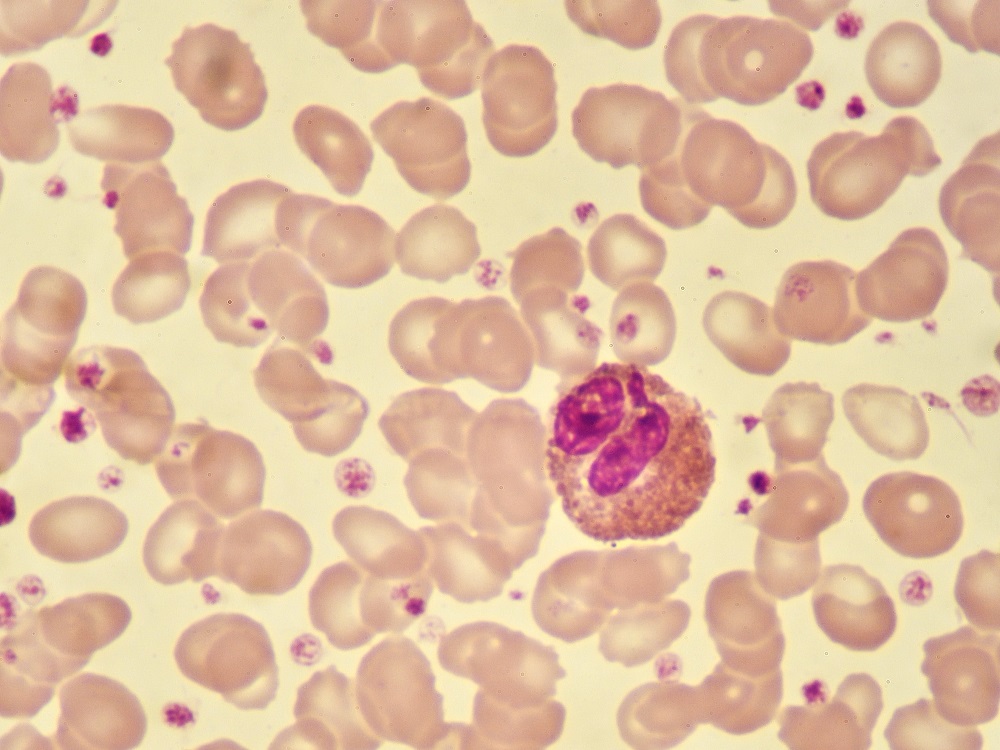 blood-eosinophilia-targeted-copd-treatment-laba-ics-vs-lamas