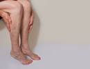 Varicose Veins May Increase Risk for Pulmonary Embolism Varicose Veins May Increase Risk for Pulmonary Embolism