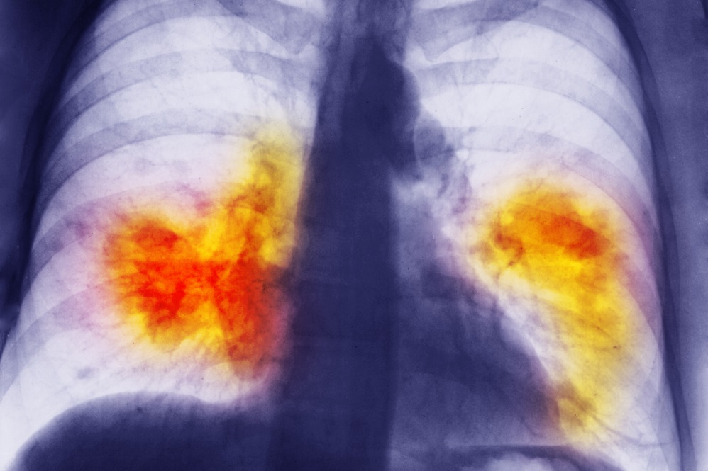 Lung Cancer Risk May Be Predicted by Frequency of COPD