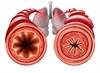 Lung Function in Asthma Improves With Add-On Tiotropium Lung Function in Asthma Improves With Add-On Tiotropium