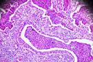 Pneumonia-Induced Acute Lung Failure: Angiopoietin-2 Levels May Predict Severity Pneumonia-Induced Acute Lung Failure: Angiopoietin-2 Levels May Predict Severity