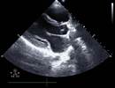 Middle-Aged Woman With Progressive Exertional Dyspnea Middle-Aged Woman With Progressive Exertional Dyspnea
