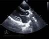 Middle-Aged Woman With Progressive Exertional Dyspnea Middle-Aged Woman With Progressive Exertional Dyspnea