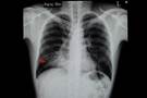 No Benefit From Prophylactic Antimicrobials in Aspiration Pneumonitis No Benefit From Prophylactic Antimicrobials in Aspiration Pneumonitis