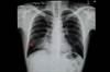 No Benefit From Prophylactic Antimicrobials in Aspiration Pneumonitis No Benefit From Prophylactic Antimicrobials in Aspiration Pneumonitis