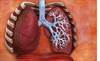 SCIT May Cut Long-Term Asthma Med Use in Pediatric Allergic Asthma SCIT May Cut Long-Term Asthma Med Use in Pediatric Allergic Asthma