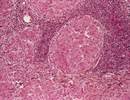 Cavity Volume and Proximity to Airway May Affect Tuberculosis Treatment Cavity Volume and Proximity to Airway May Affect Tuberculosis Treatment